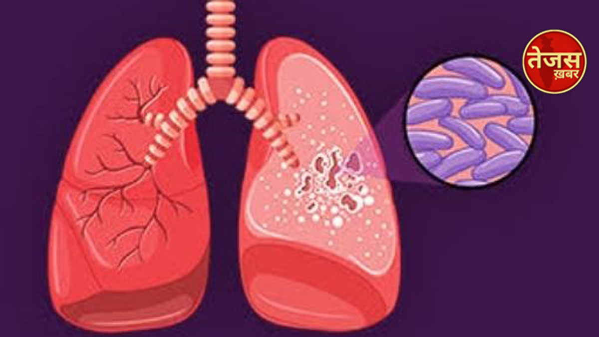 अगर गर्भवती में प्रतीत हों टीबी के लक्षण तो देर न करें, फौरन इलाज़ शुरू करें